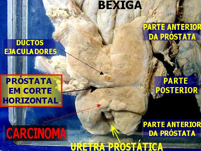 cancer de prostata linfonodos)