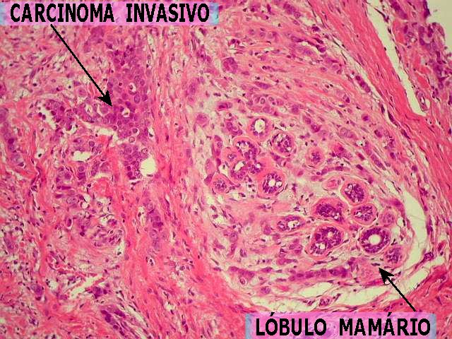cancer mamar malign invaziv