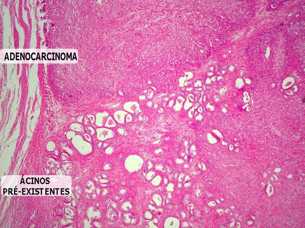 Acinaris adenocarcinoma, Prosztatarák