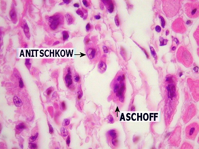 Anitschkow Myocytes