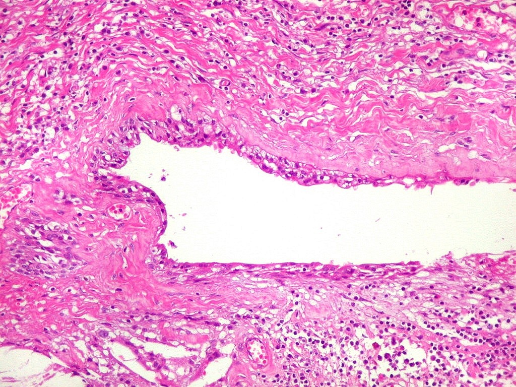 epitelio plano estratificado