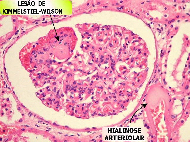 Glomerulosclerose intercapilar nodular de Kimmelstiel-Wilson.