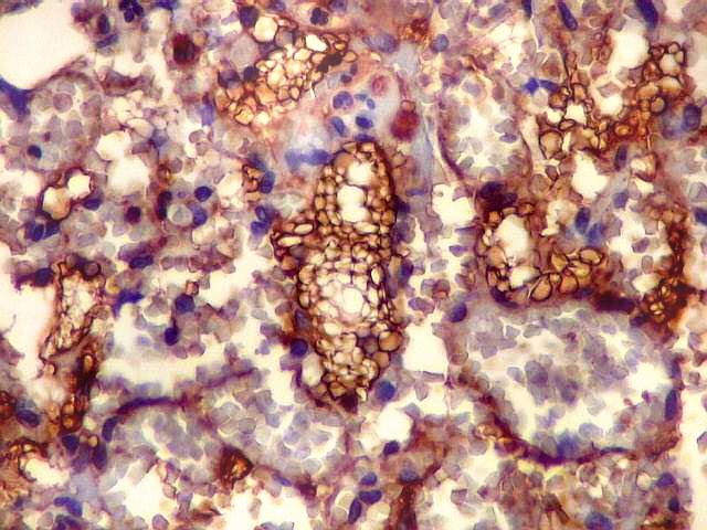 Diagnostic immunohistochemistry dabbs pdf creator