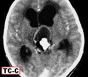 Pineal Teratoma